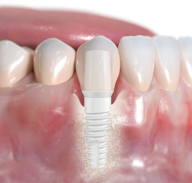 Künstliche Zahnwurzel: Das Zirkonimplantat oder Keramikimplantat.
Bildquelle: ©Nobel Biocare Services AG
 