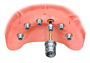 6 Zahnimplantate im Oberkiefer mit Aufbauten: Abutments - Verbindungselement zwischen Implantatschraube und Zahnkrone. 6 Zahnimplantate im Oberkiefer mit Aufbauten: Abutments - Verbindungselement zwischen Implantatschraube und Zahnkrone.
