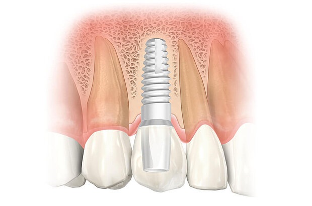 Lange Lebensdauer mit guter Nachsorge und Implantatpflege. Lange Lebensdauer mit guter Nachsorge und Implantatpflege.