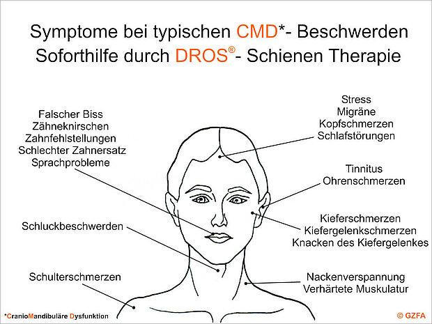 Unterschiedliche Symptome bei CMD-Beschwerden: Soforthilfe durch die DROS®-Schienentherapie. Unterschiedliche Symptome bei CMD-Beschwerden: Soforthilfe durch die DROS-Schienentherapie.