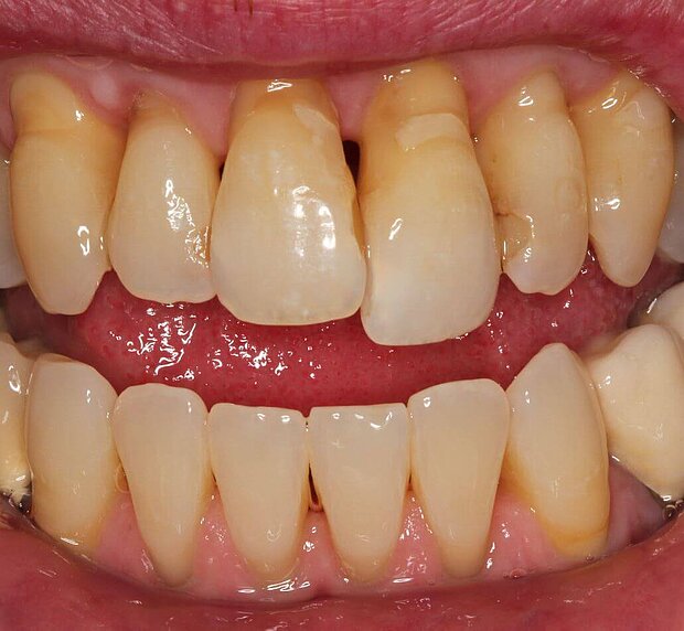 Gingivitis: Bakterielle Beläge im Oberkiefer sind der Auslöser für eine Zahnfleischentzündung und Zahnlockerung.
Gingivitis: Bakterielle Beläge im Oberkiefer sind der Auslöser für eine Zahnfleischentzündung und Zahnlockerung.
Bildquelle: ©GZFA