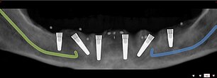 Mitgliedschaft Implantologie: Spezialisierung auf zahnlose Patienten. Implantatplanung mit Nervdarstellung im Unterkiefer - 6 Implantate als Basis für festsitzenden Zahnersatz. Mitgliedschaft Implantologie: Spezialisierung auf zahnlose Patienten. Implantatplanung mit Nervdarstellung im Unterkiefer - 6 Implantate als Basis für festsitzenden Zahnersatz. Mitgliedschaft Implantologie: Spezialisierung auf zahnlose Patienten.Implantatplanung mit Nervdarstellung im Unterkiefer - 6 Implantate als Basis für festsitzenden Zahnersatz.